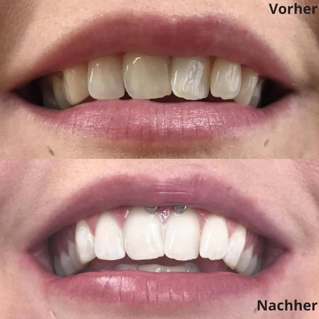 Gelbe Zähne trotz täglichem Putzen?