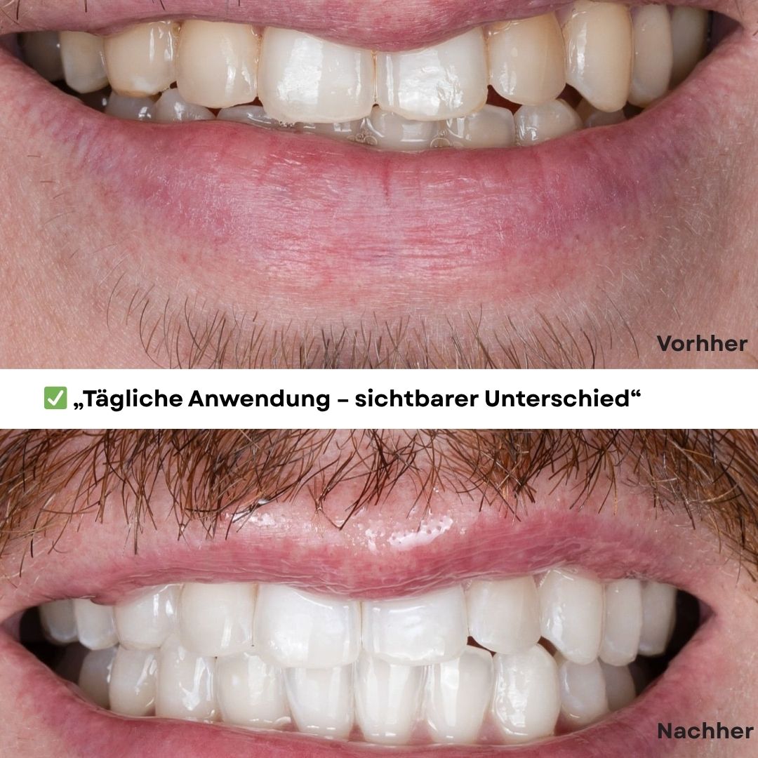 JetSmile – Dein Weg zu weißen Zähnen
