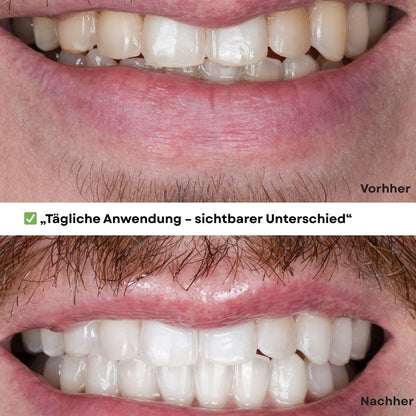 JetSmile – Dein Weg zu weißen Zähnen