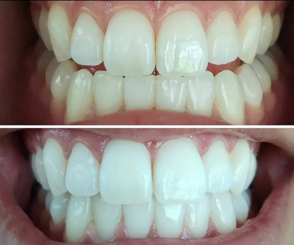 LED Whitening Kit