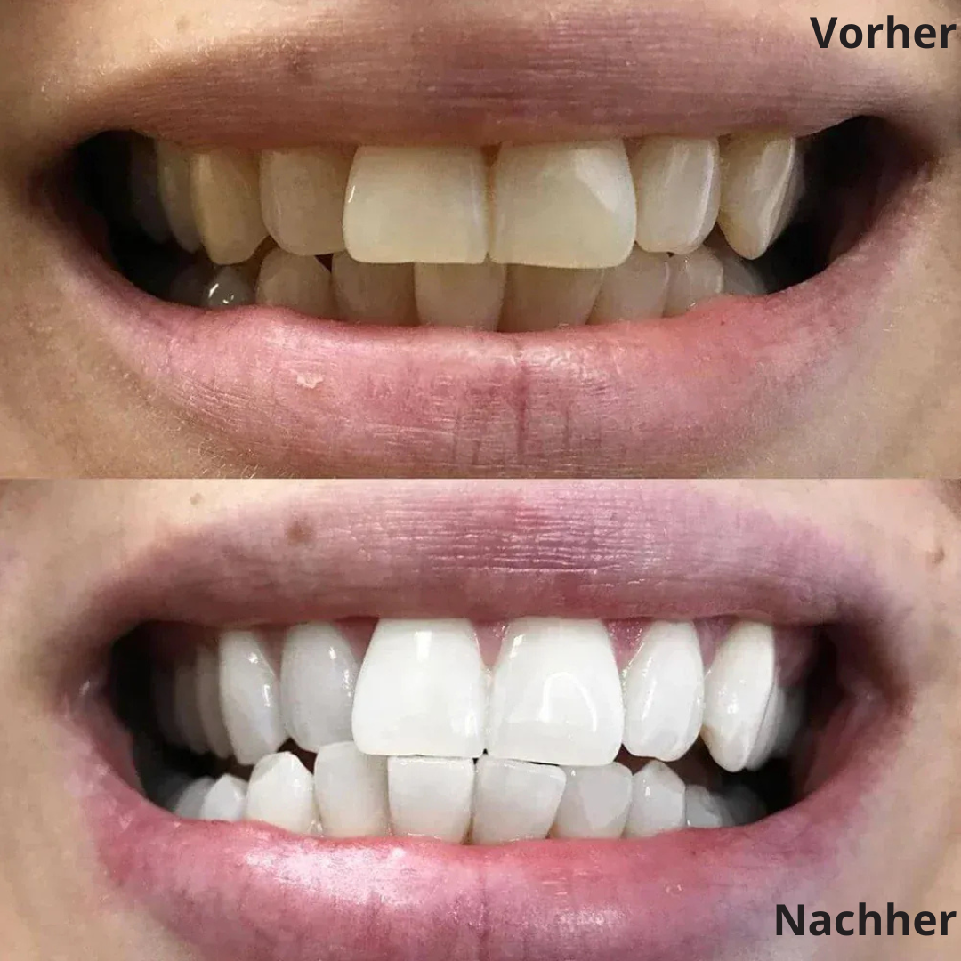 JetSmile – Dein Weg zu weißen Zähnen