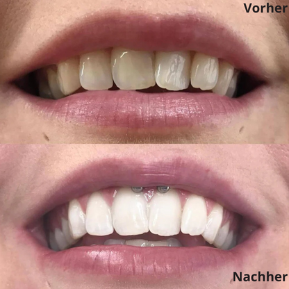 JetSmile – Dein Weg zu weißen Zähnen