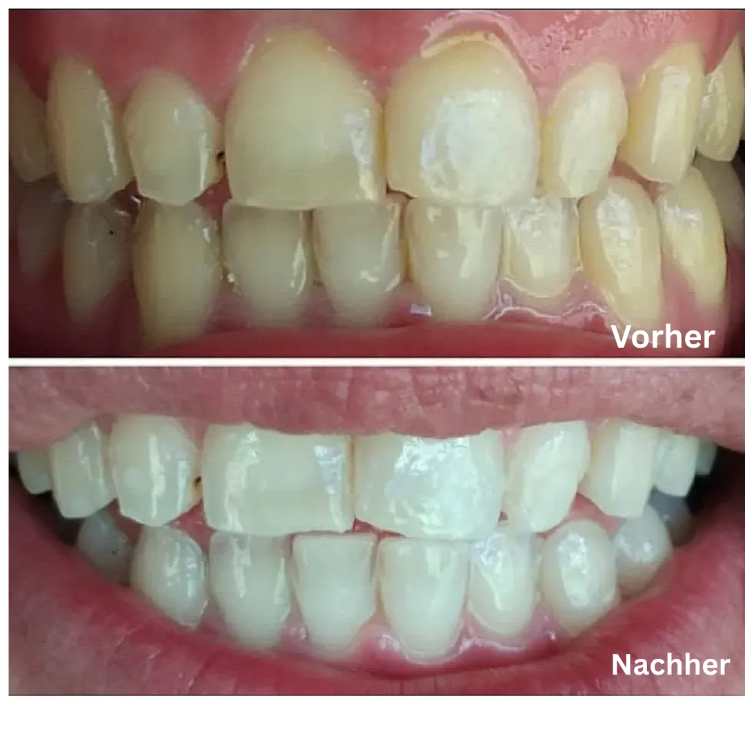 JetSmile Whitening Pen