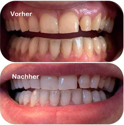 LED Whitening Kit
