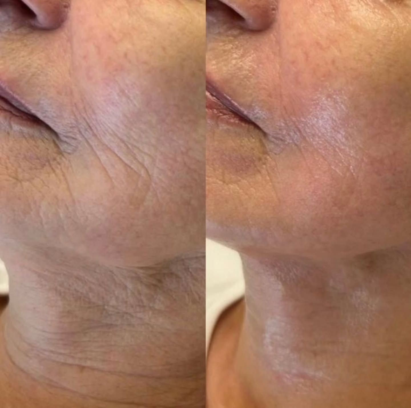 Retinal Shot & Retinol Shot – Gegen Falten, Augenringe & Tränensäcke